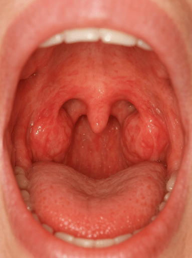 تصویر لوزه ها از بهترین جراح لوزه شمال تهران